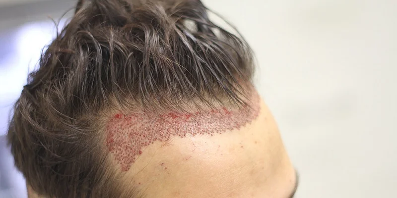 قیمت کاشت مو